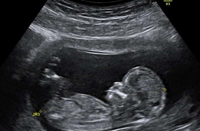 12 Недель Беременности Фото Узи Ребенка
